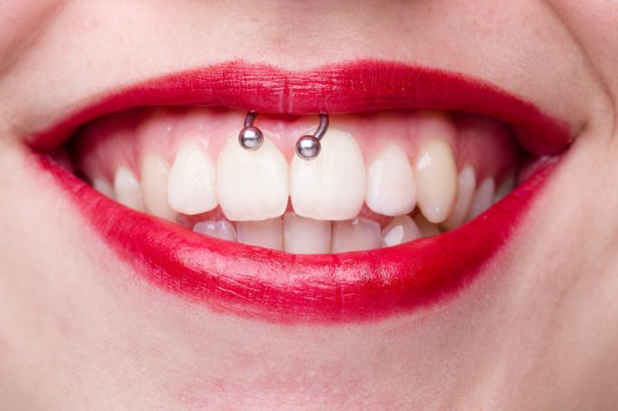 Smiley -  Lippenbändchenpiercing
